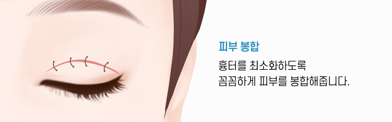절개쌍꺼풀 수술방법