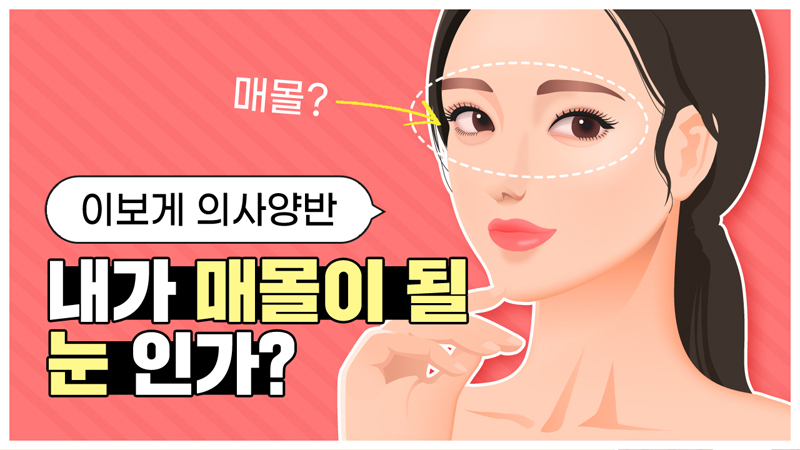 비절개쌍꺼풀이란