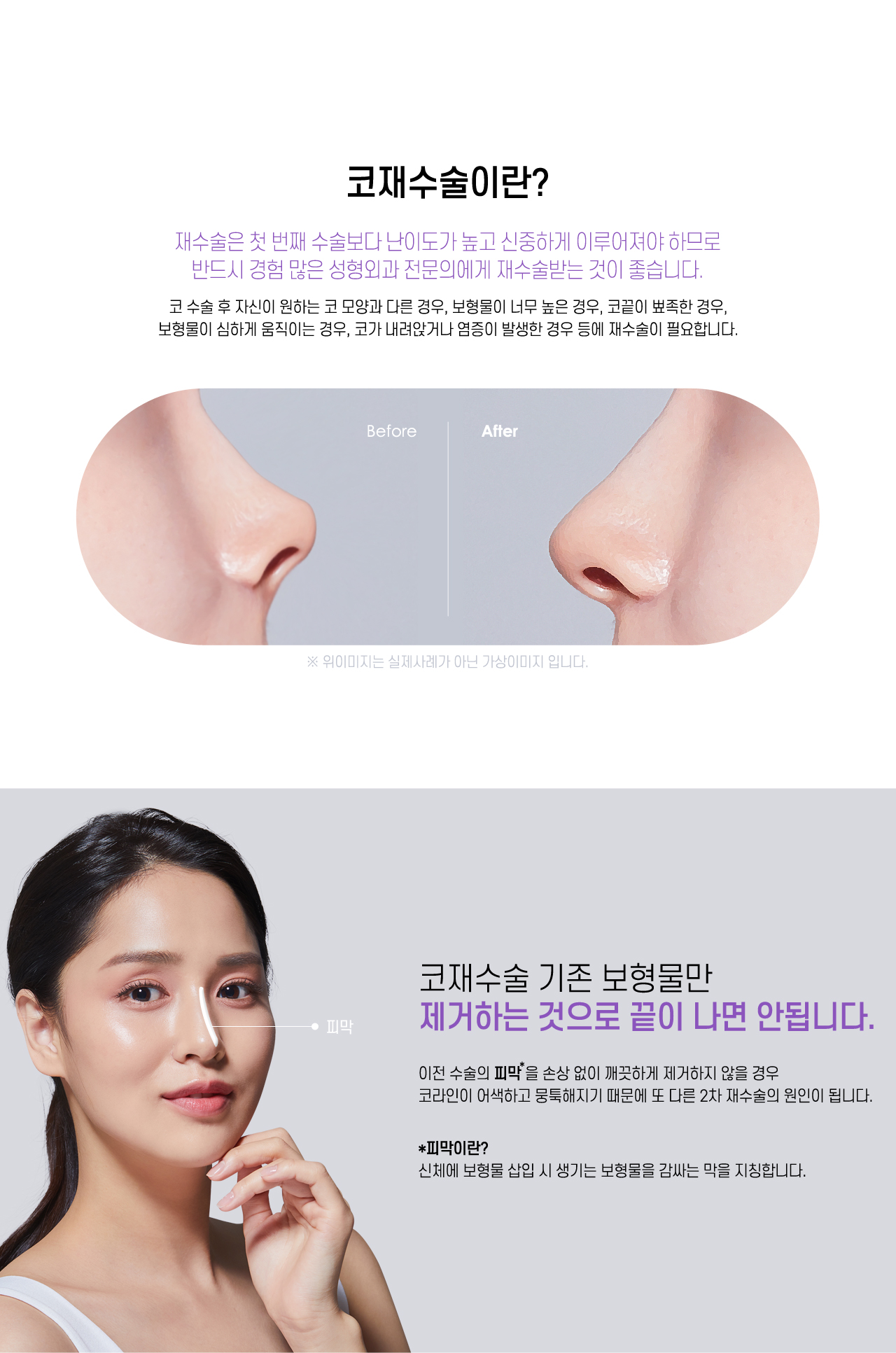 코재수술이란?
