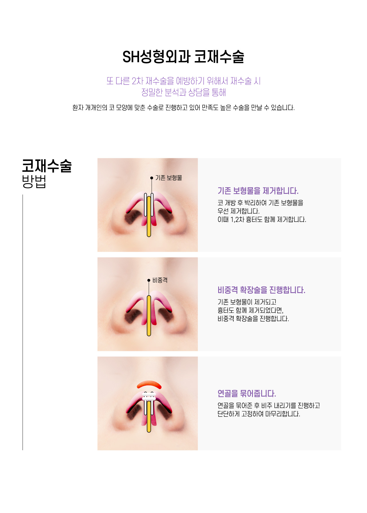 SH성형외과 코재수술