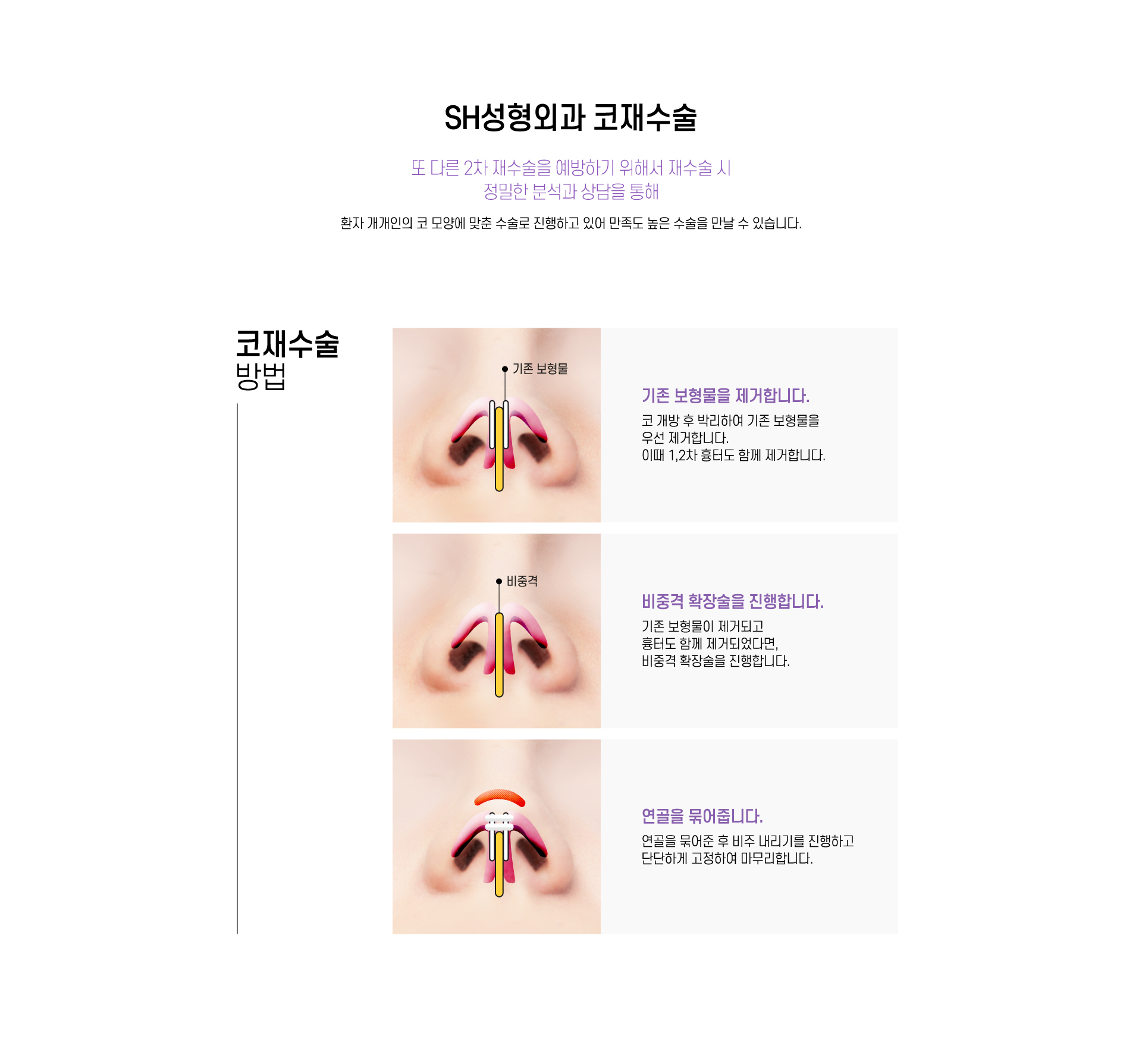 SH성형외과 코재수술