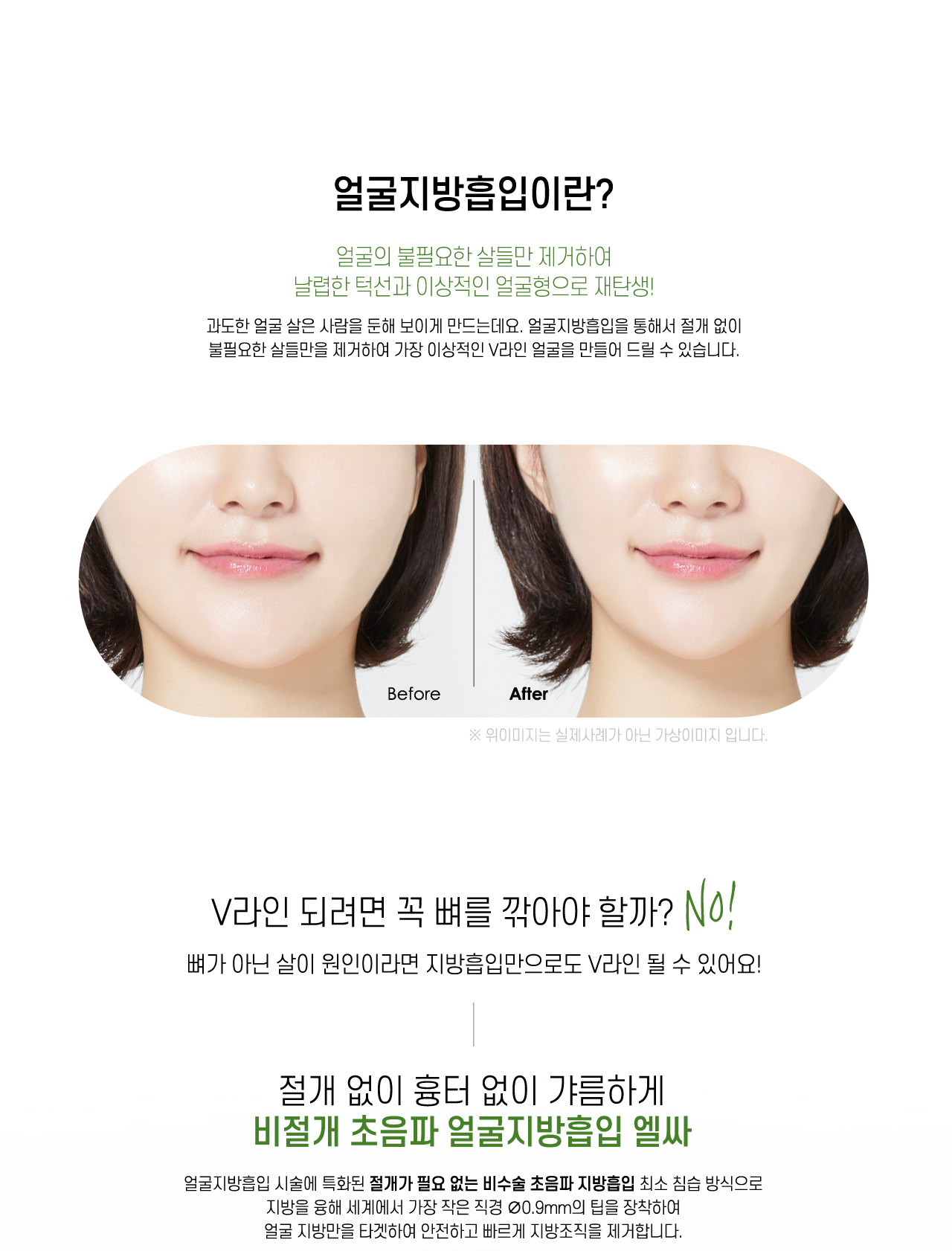 얼굴지방흡입이란?