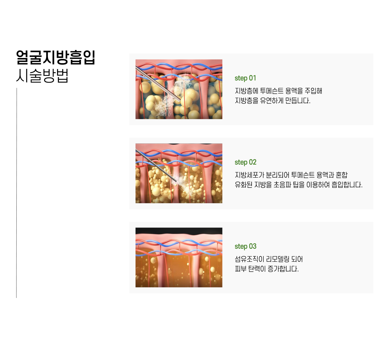 엘싸 얼굴지방흡입이 필요한 경우