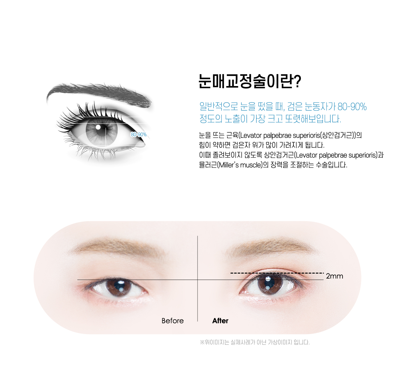 눈매교정술이란