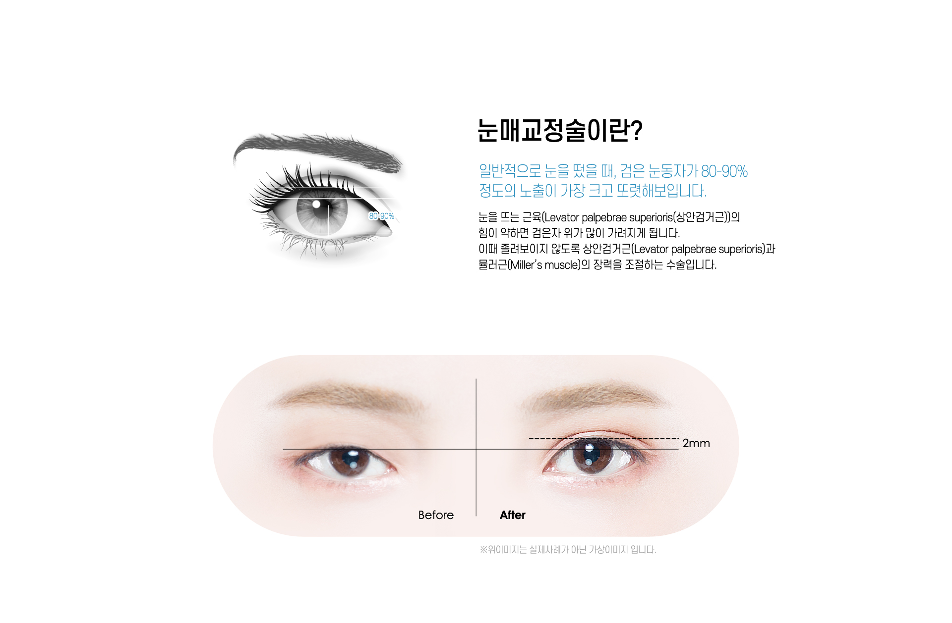 눈매교정술이란