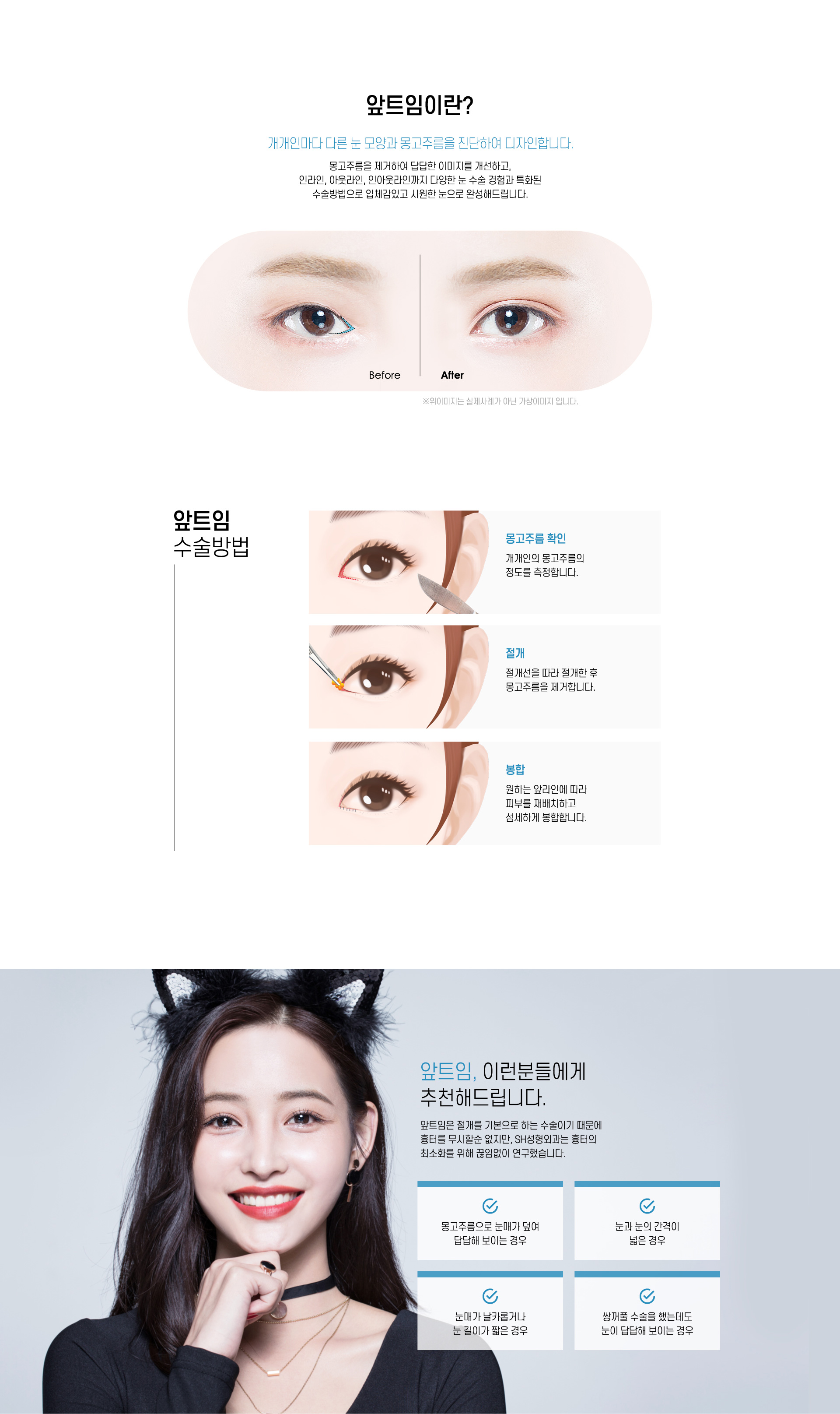앞트임