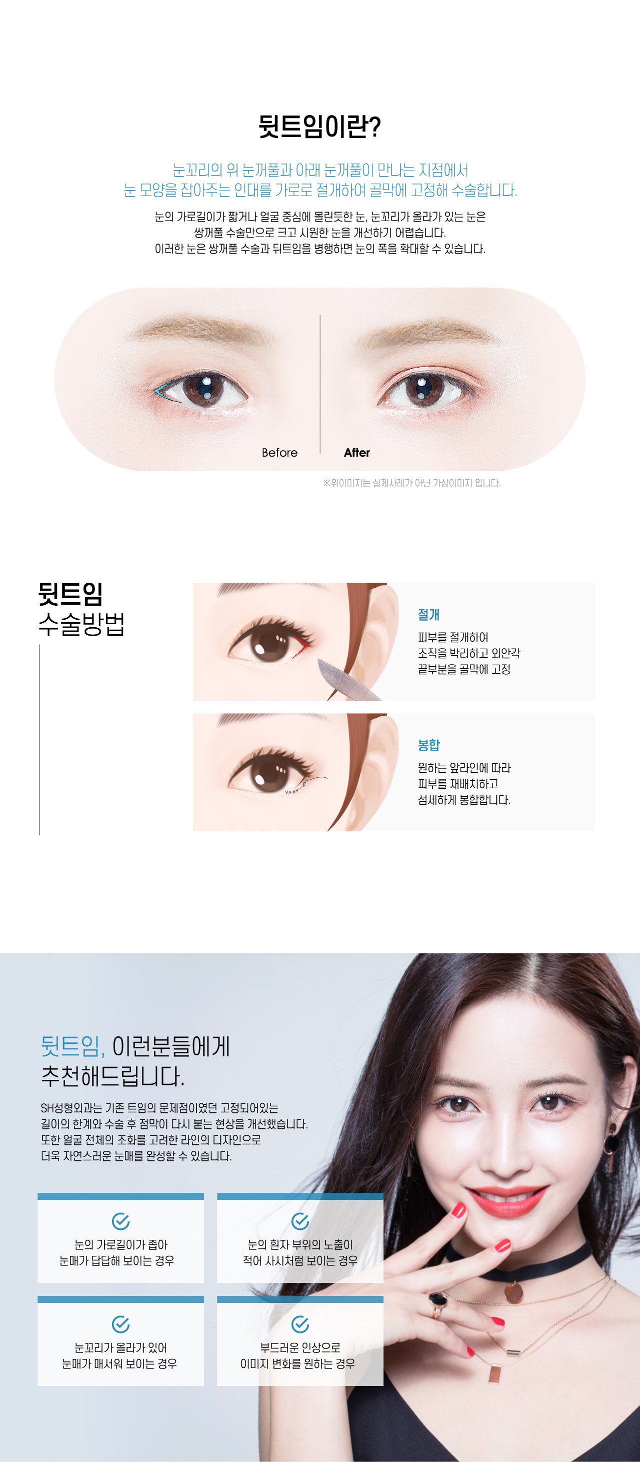 뒷트임