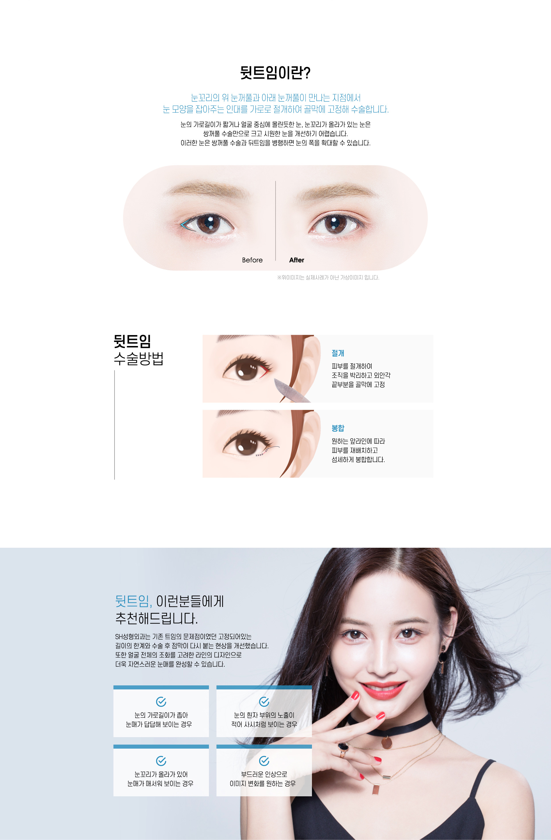 뒷트임