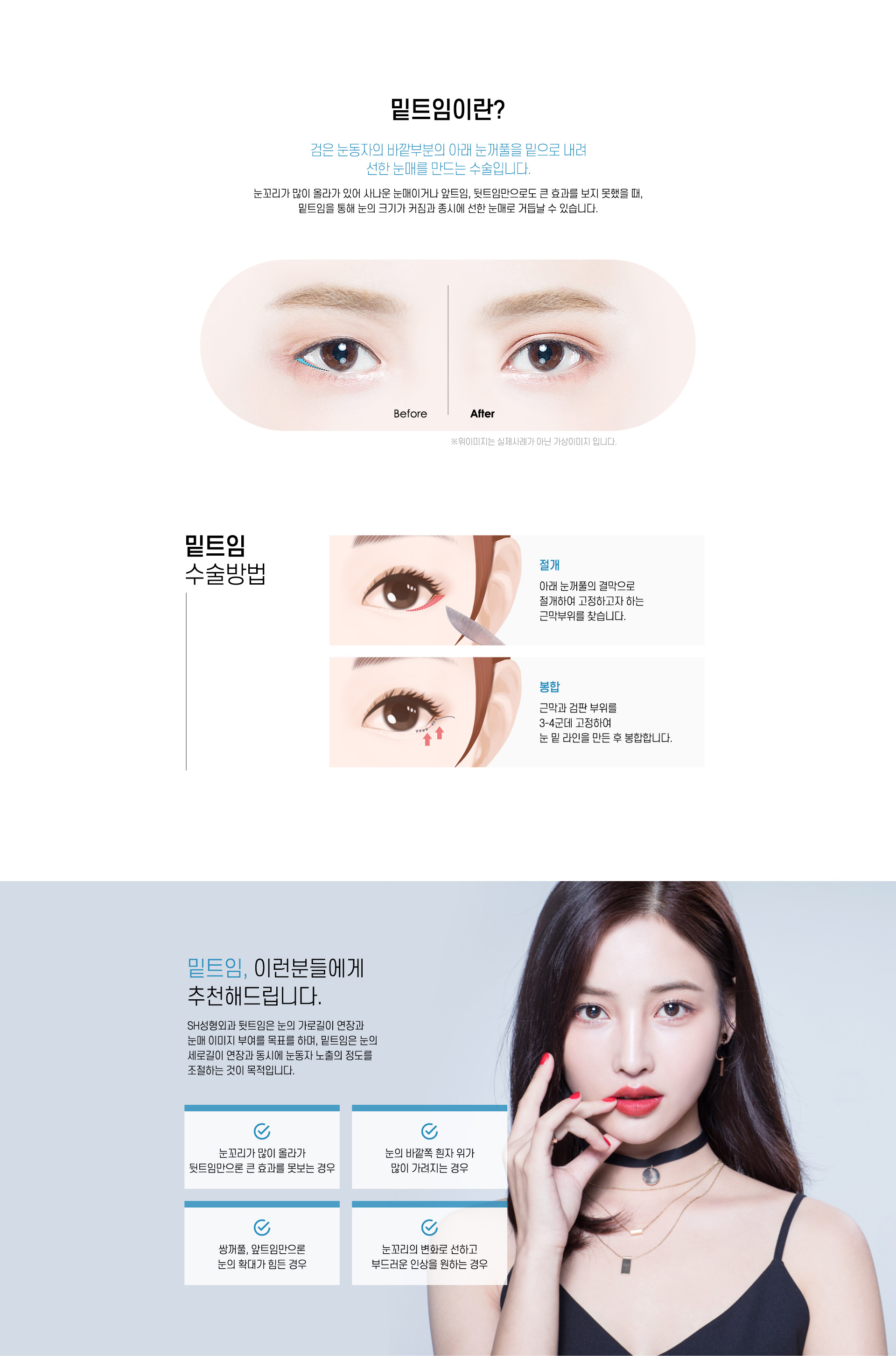 밑트임