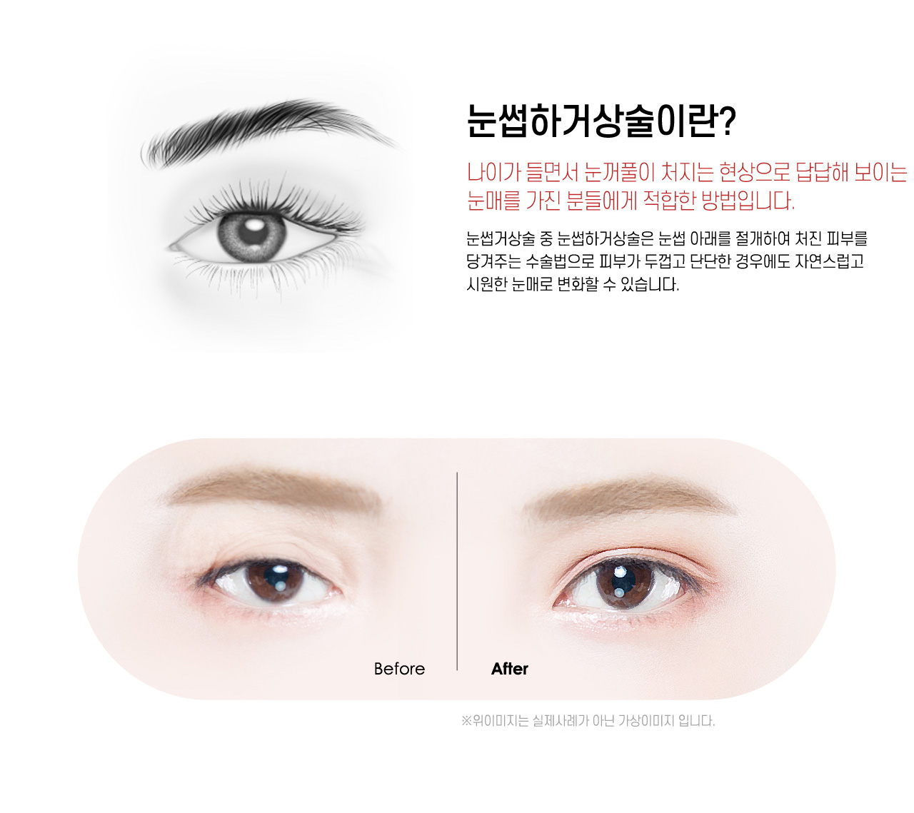 눈썹하거상술이란?