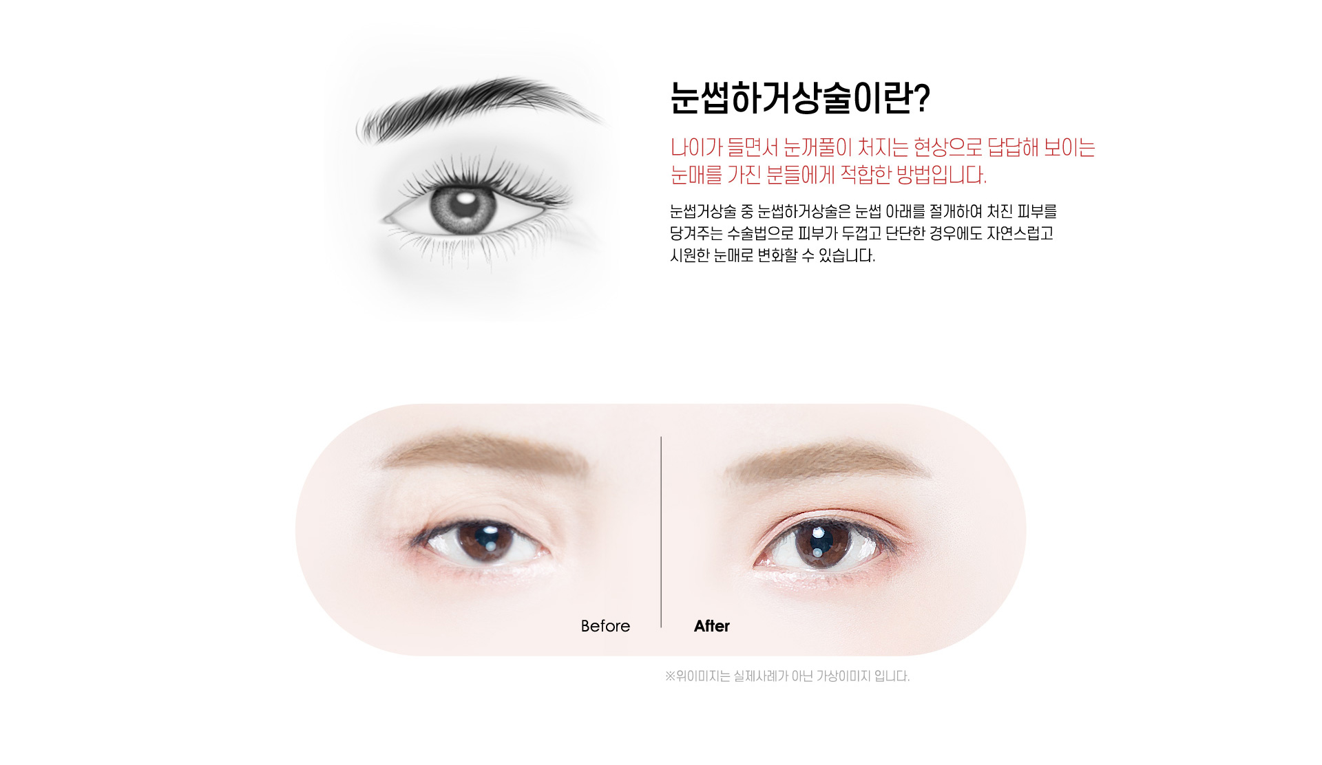 눈썹하거상술이란?
