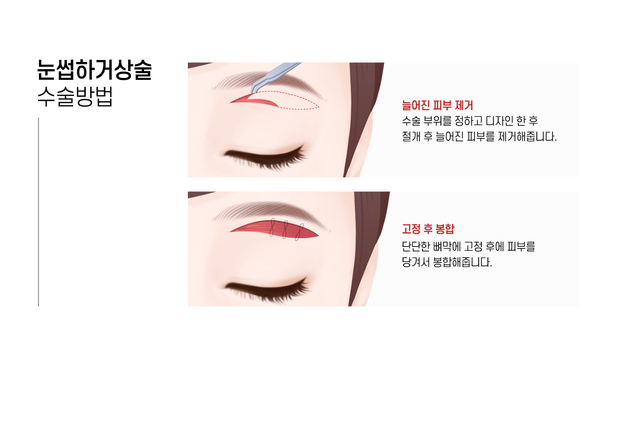 눈썹하거상술 수술방법