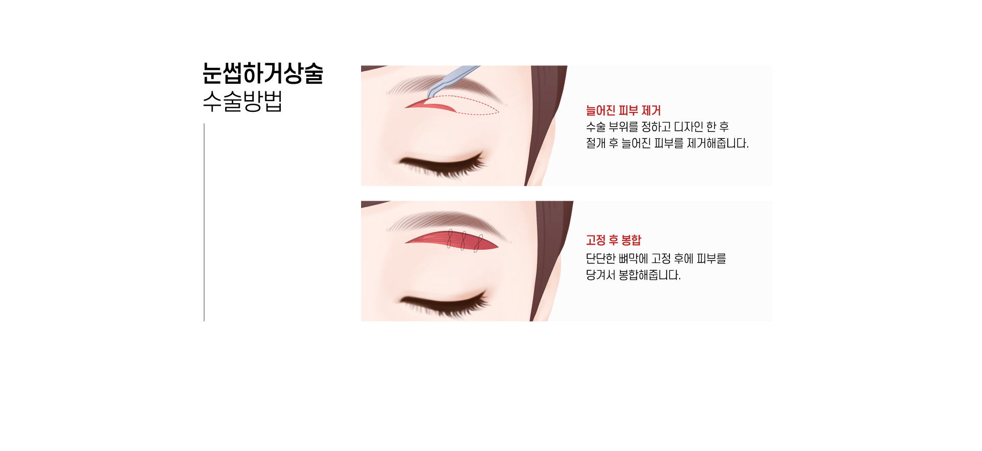 눈썹하거상술 수술방법