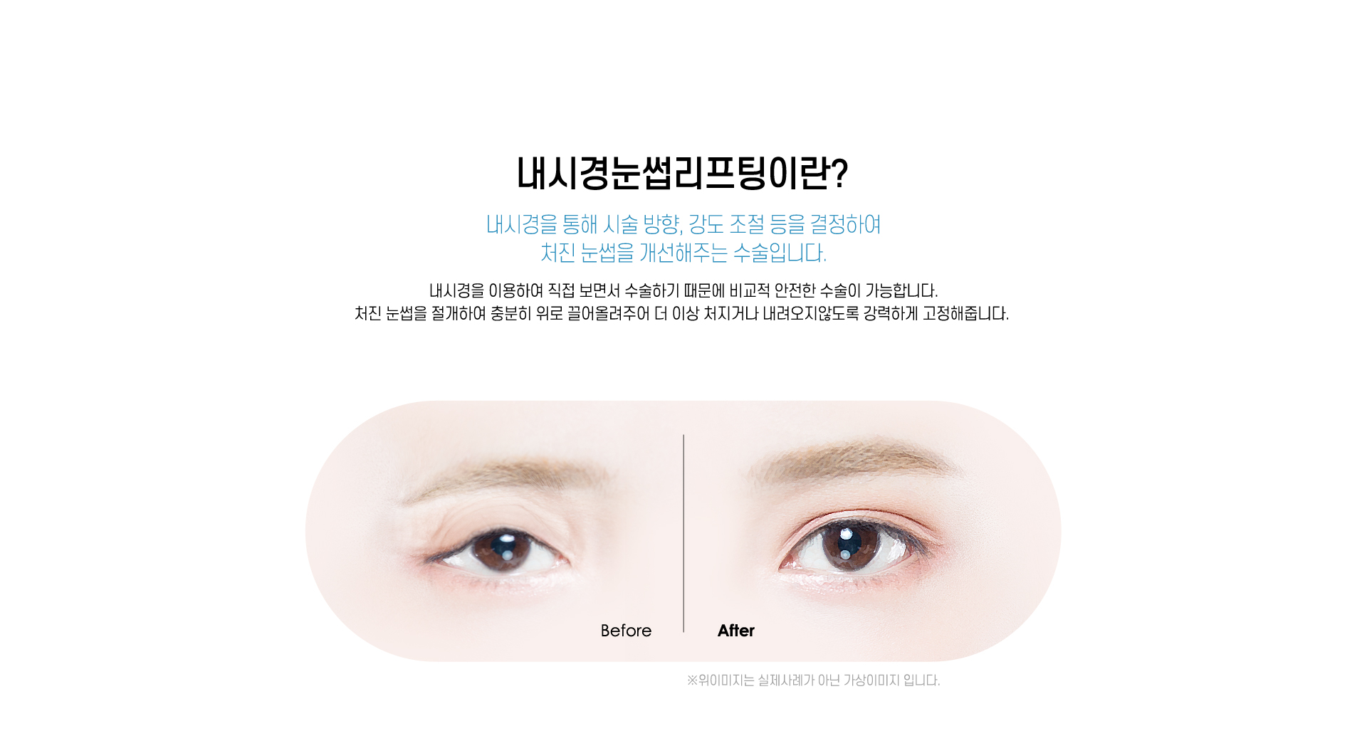 내시경눈썹리프팅 이란?