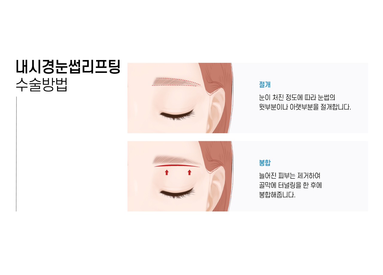 내시경눈썹리프팅 수술방법