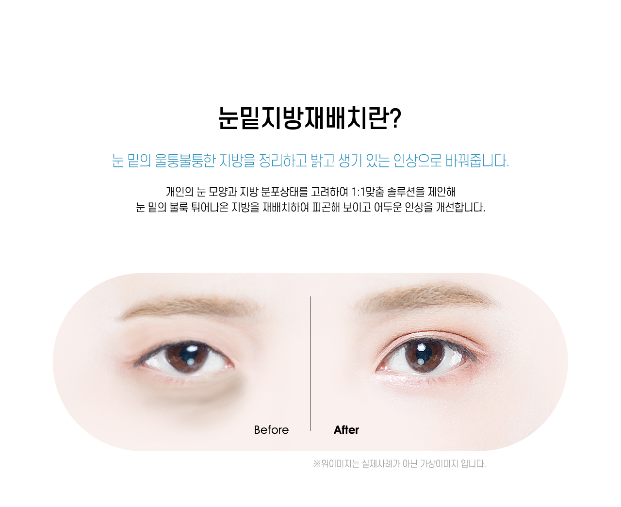 눈밑지방재배치란