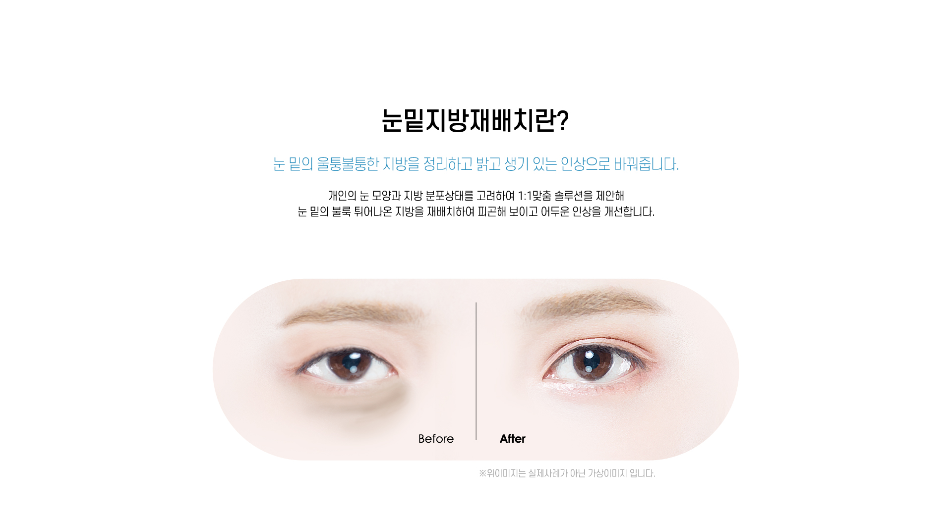눈밑지방재배치란