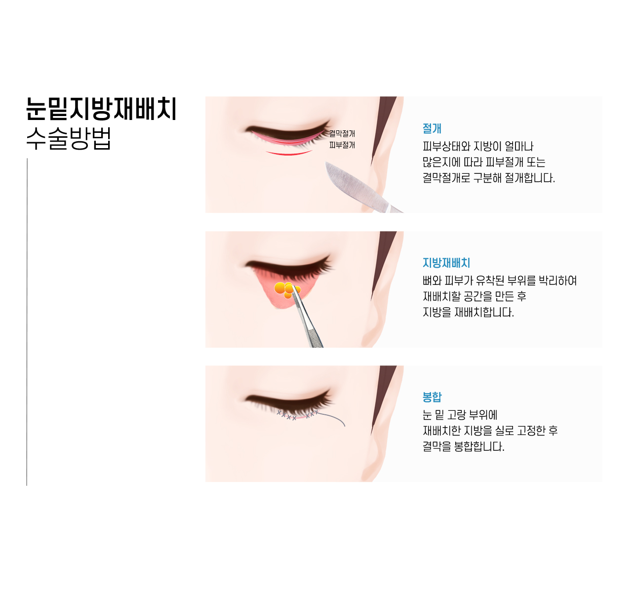 수술방법