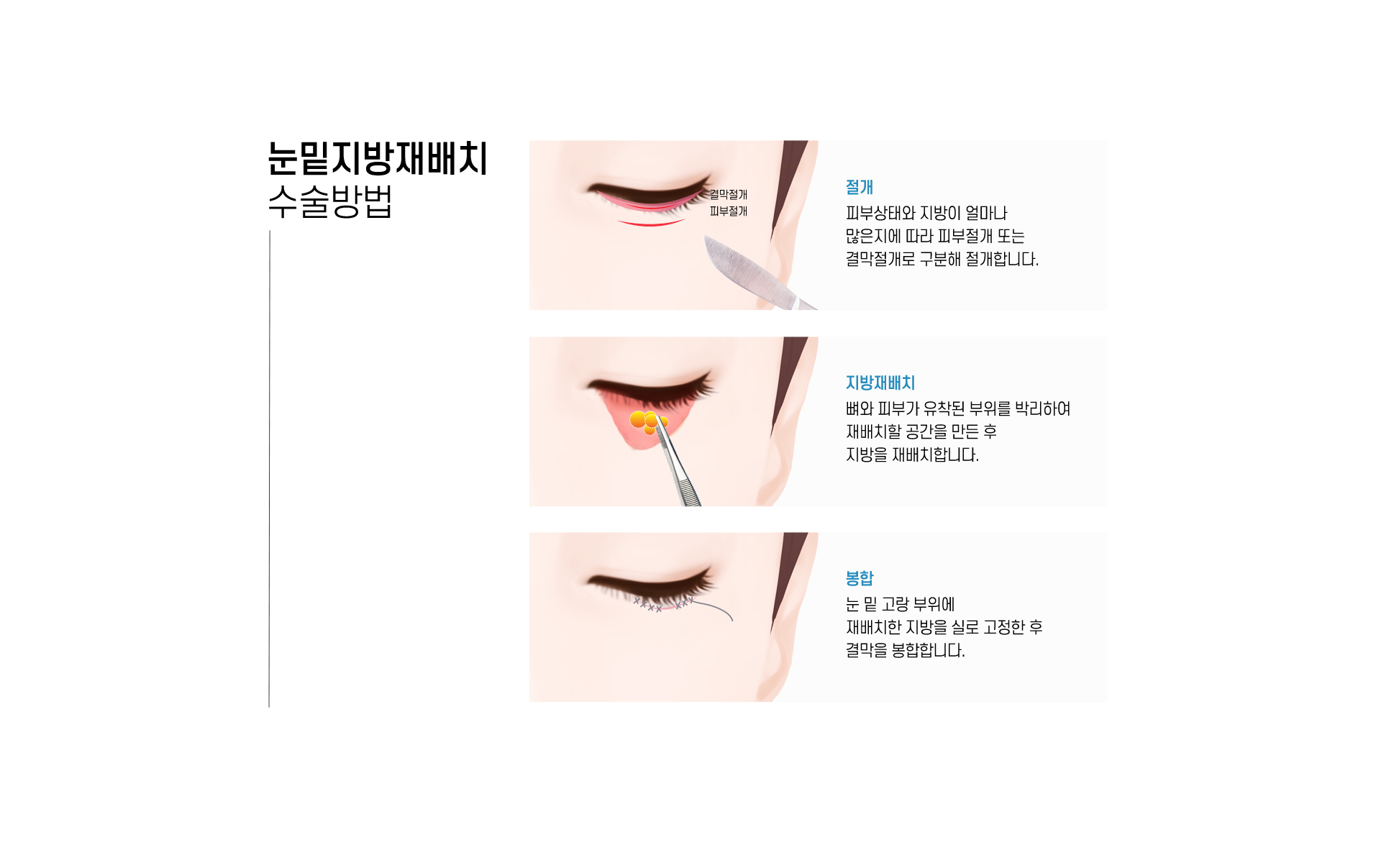 수술방법