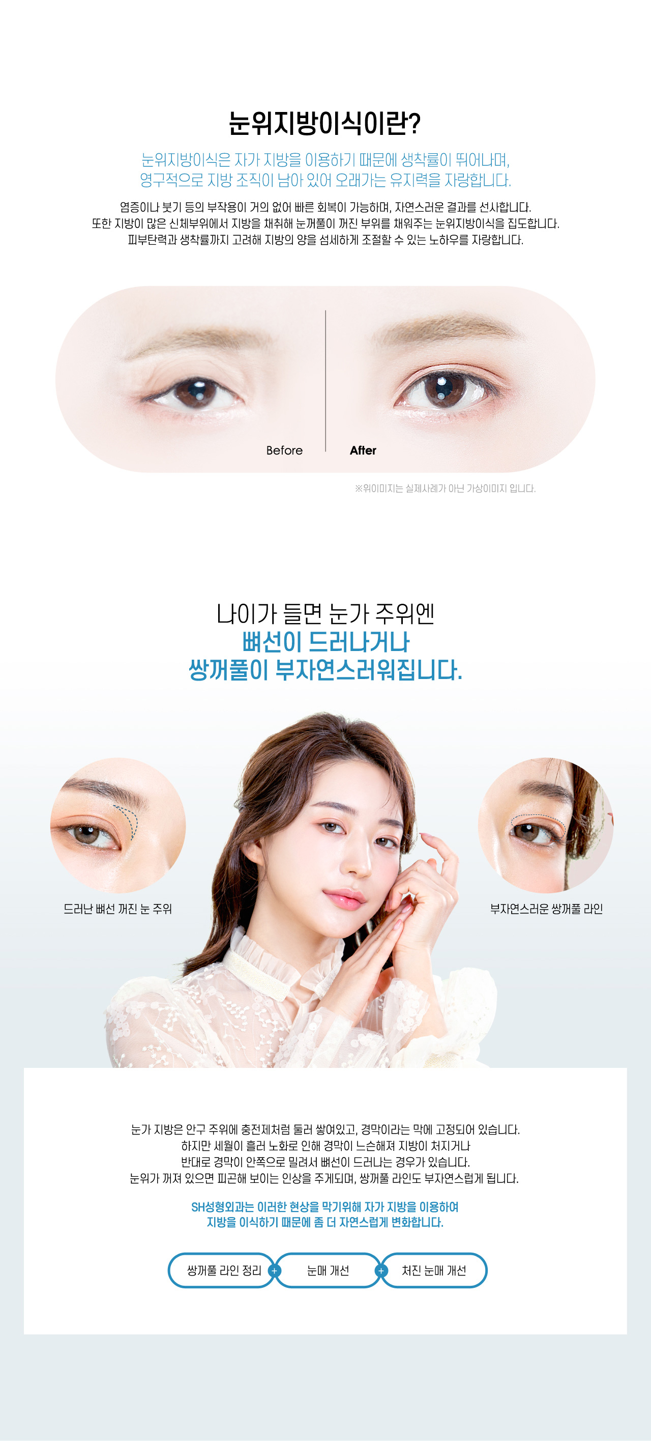 눈위지방이식이란?