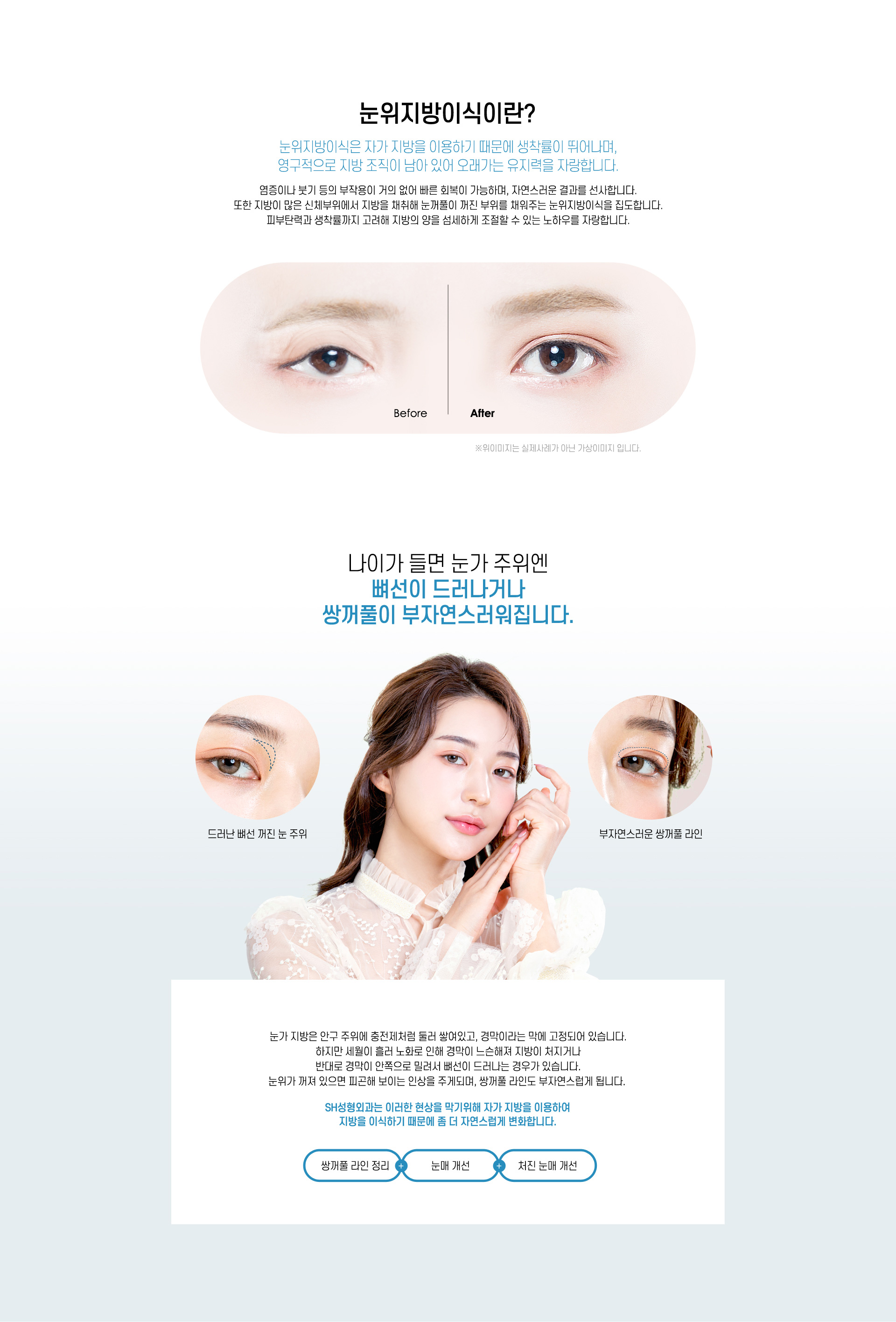 눈위지방이식이란?
